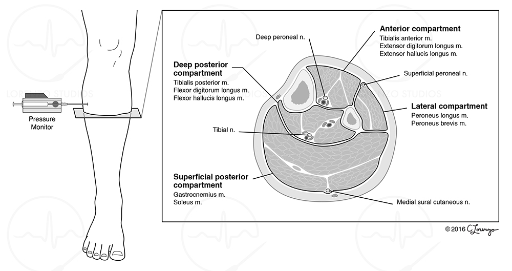 Lower Limb Compartment Testing