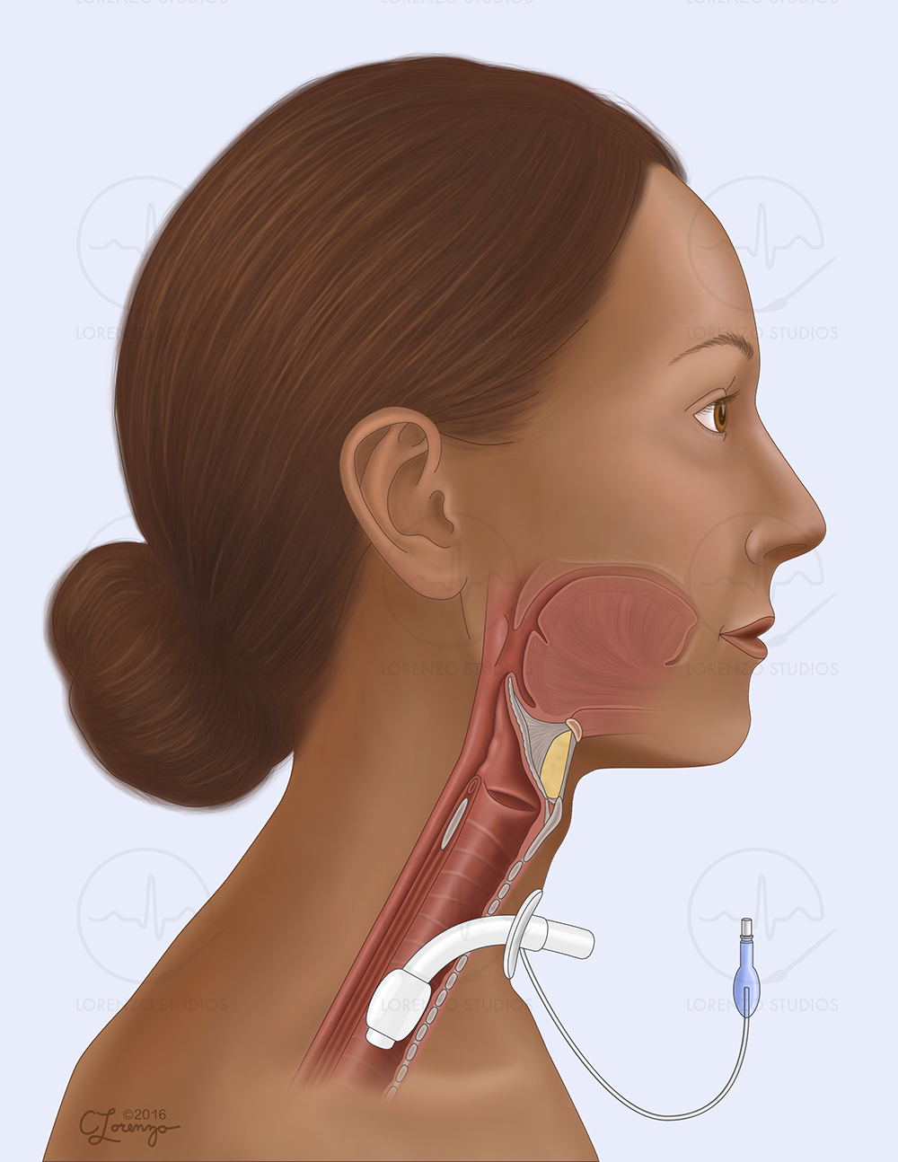 Tracheostomy